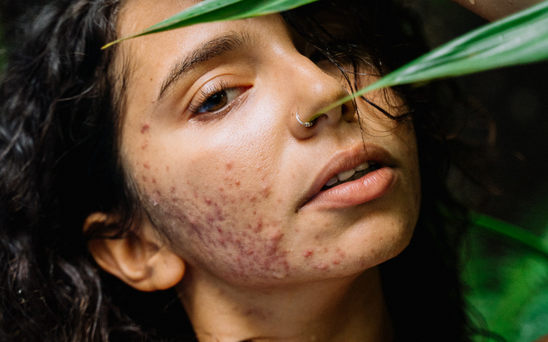 Consejos para el cuidado de la piel con acné